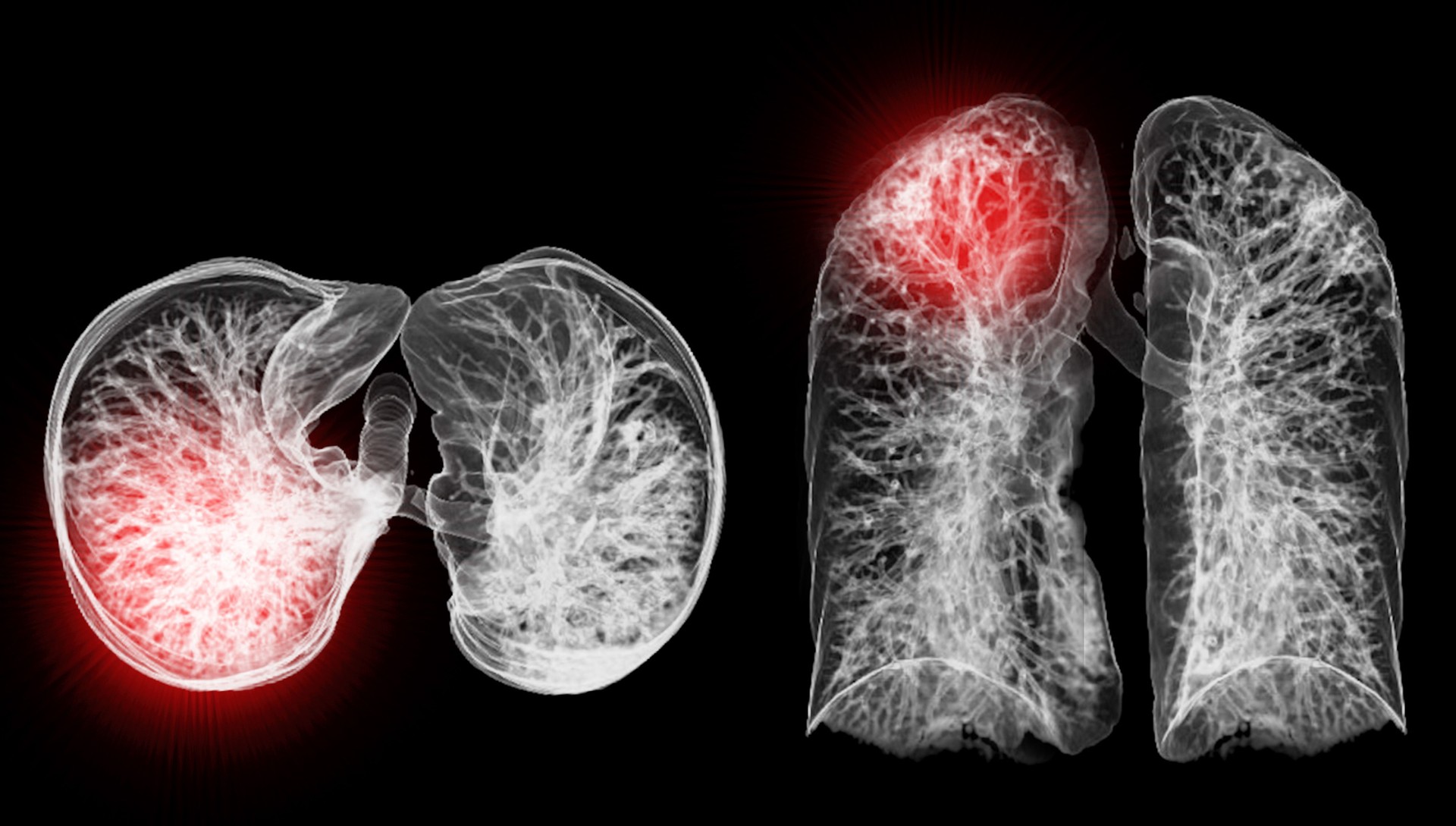A CT chest 3D scan displaying a lesion at the right upper lobe offers a detailed visualization, aiding in precise identification and  treatment planning.